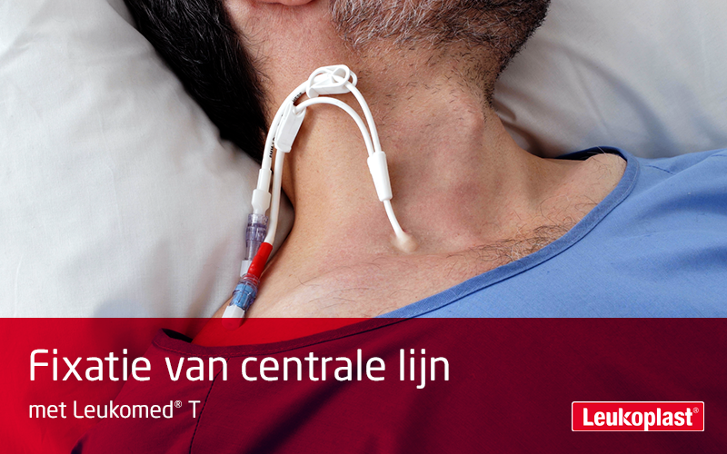 In deze video zien we hoe een centrale lijn wordt gefixeerd met een steriele transparente film: we zien een  zorgprofessional Leukomed T op de hals van een patiënt aanbrengen en de lijn fixeren. In deze video zien we hoe een centrale lijn wordt gefixeerd met een steriele transparente film: we zien een  zorgprofessional Leukomed T op de hals van een patiënt aanbrengen en de lijn fixeren.